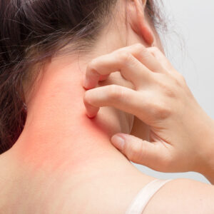 Eczema