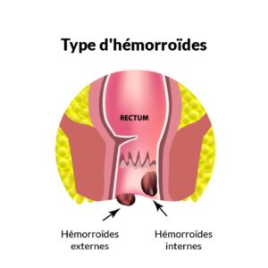 Hemorrhoidal crisis