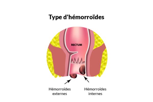 Hemorrhoidal crisis