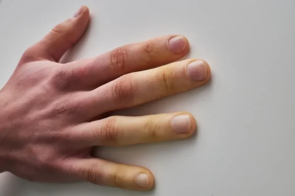 SYNDROME DE RAYNAUD