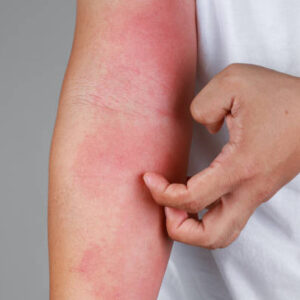 Allergy